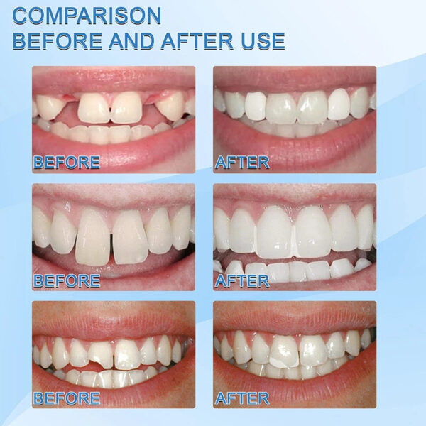 Moldable Broken Teeth Gaps Filling - Image 3