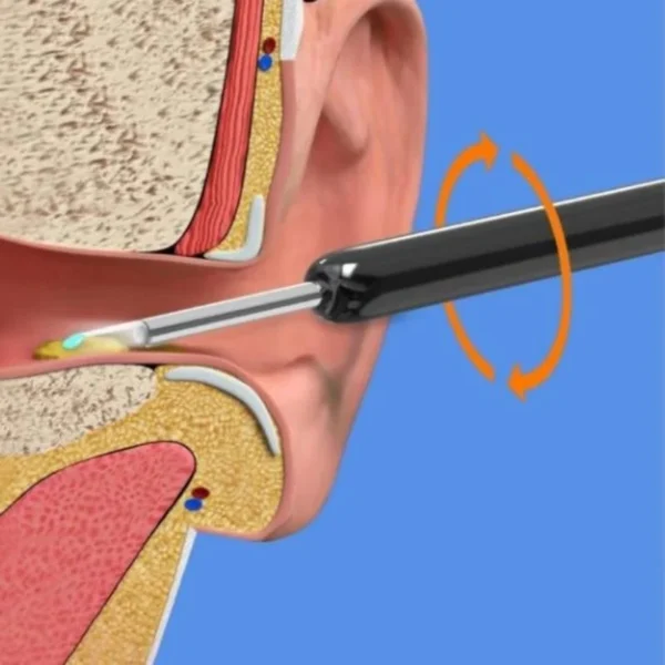 Wireless Earwax Remover Otoscope Tool - Image 4