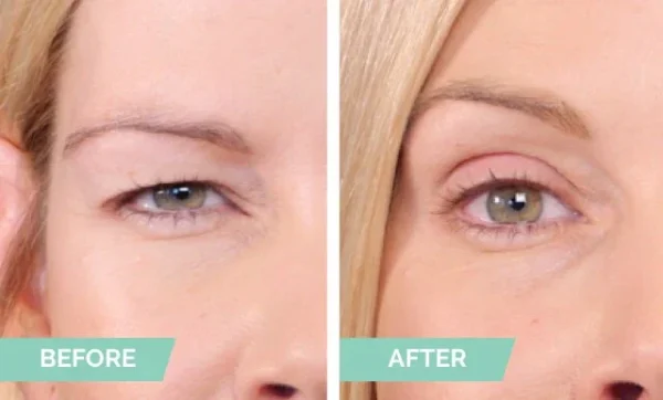 Natural Invisible Eyelid - Image 3
