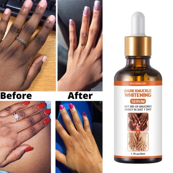Acanthosis Nigricans Therapy Oil - Image 4