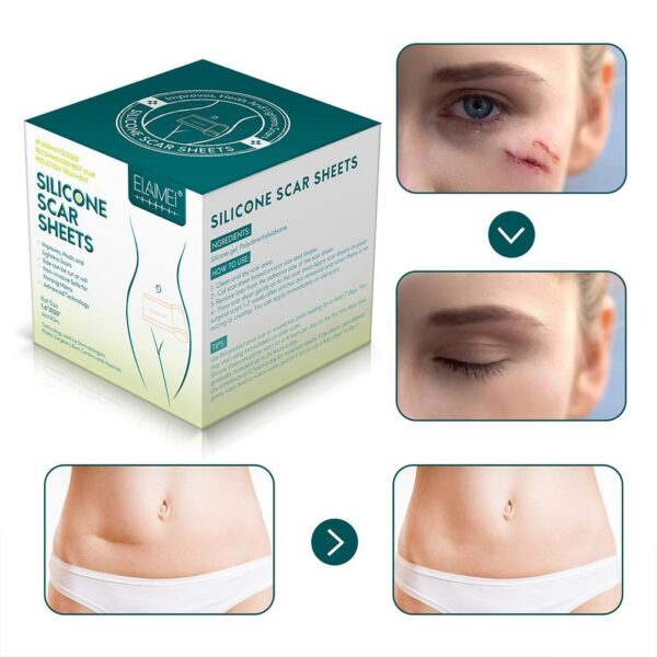 Medical Soft Silicone Gel Tape for Scar Removal - Image 3