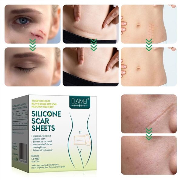 Medical Soft Silicone Gel Tape for Scar Removal - Image 5