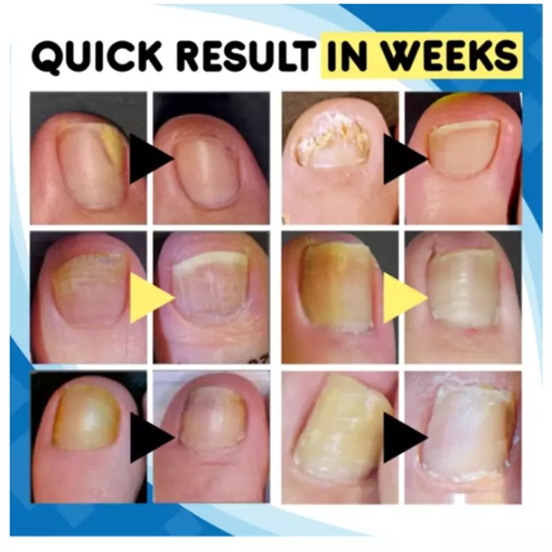 Anti-Fungal Home Treatment Set - Image 2