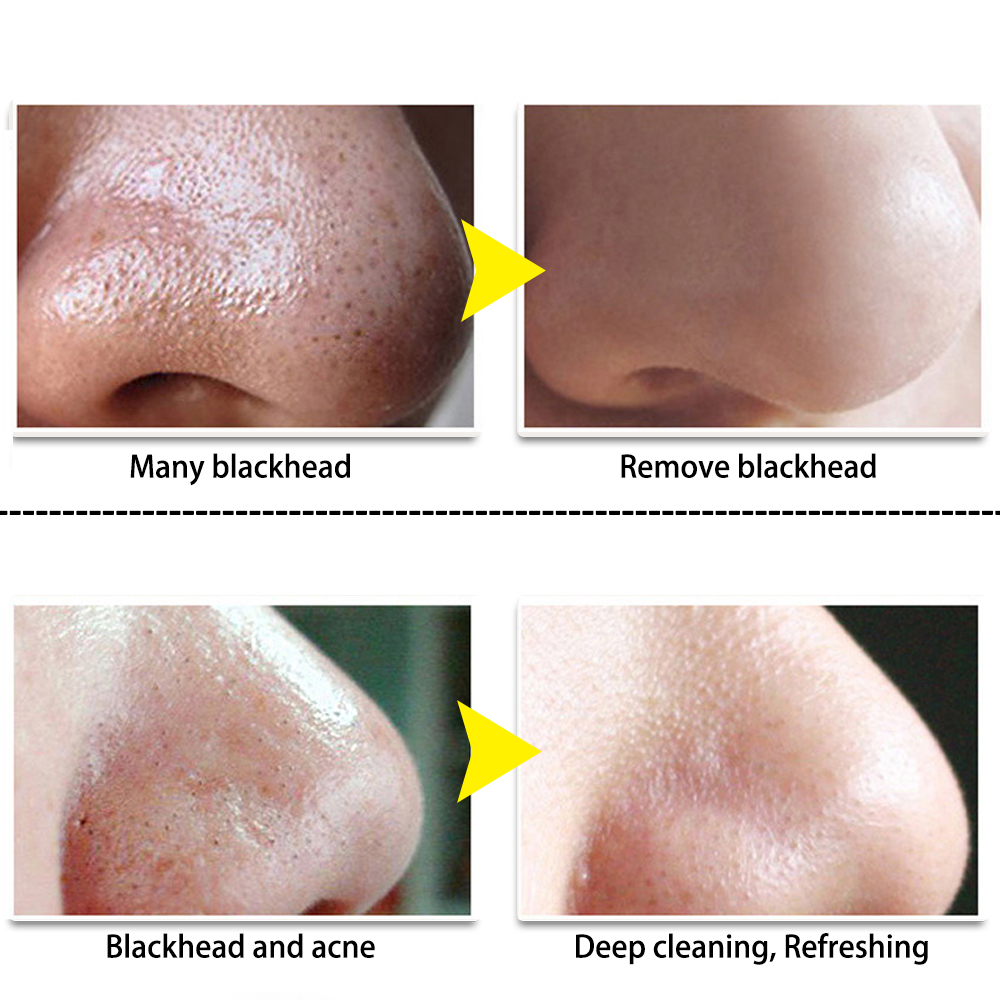 BLACKHEAD STRIP - Image 4
