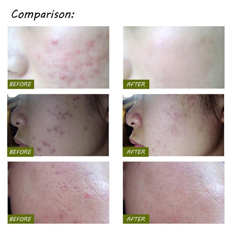 Light Therapy Acne Pen - Image 2